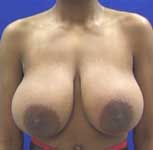 marisols breasts
